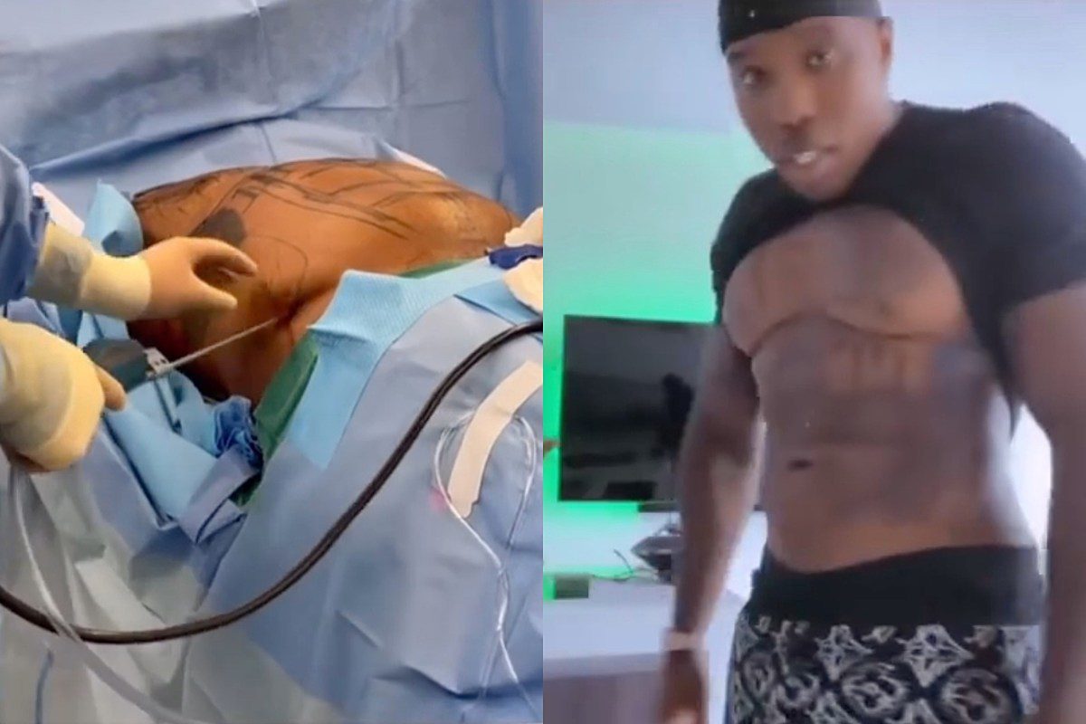 Bandman Kevo Gets Liposuction for His Abs, Hints That Other Rappers Have Done It Too