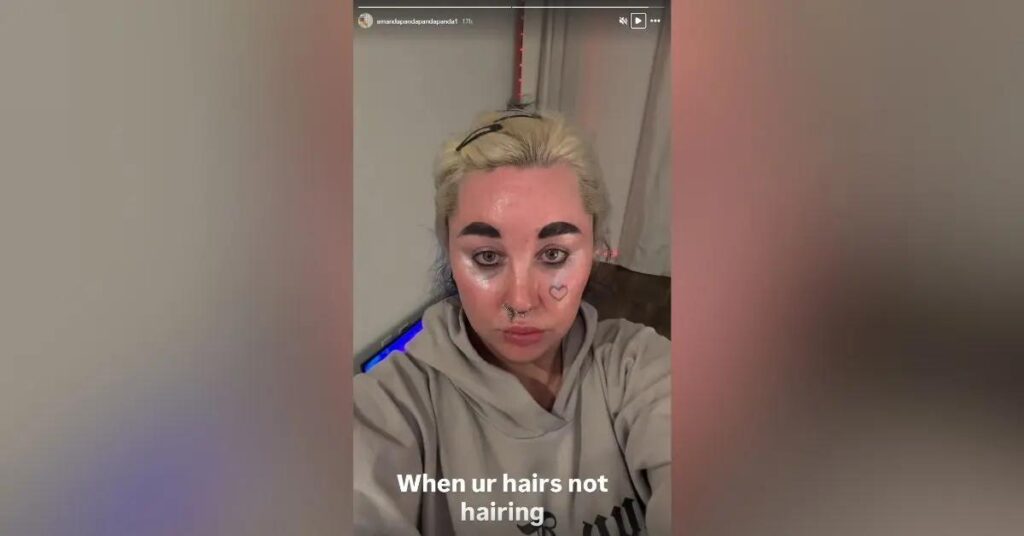 Photo of Bynes underwent blepharoplasty in 2023, a procedure that removes excess skin around the eyes.